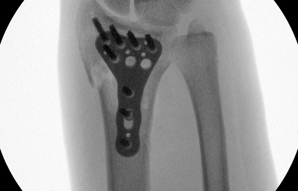 Raio-X-da-fratura-de-Dennis.jpg X-Ray